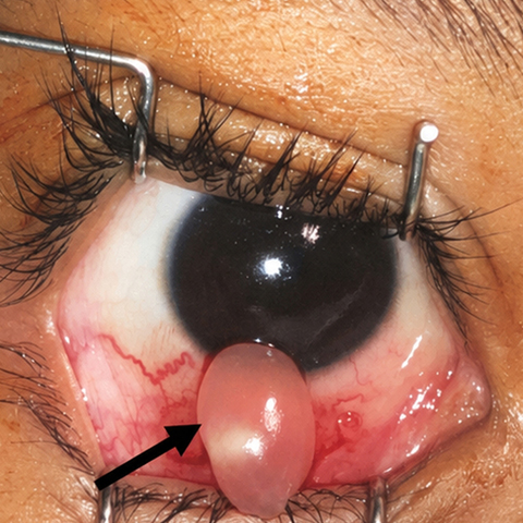 Excisional biopsy confirmed the presence of a cysticercosis cyst
