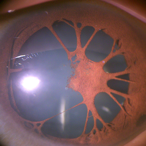 After dilation, there was a radial opacity in the lens seen at at 7 o’clock in the left eye.