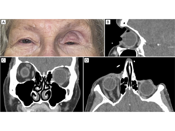Unilateral facial atrophy and orbital fat loss in Parry-Romberg syndrome