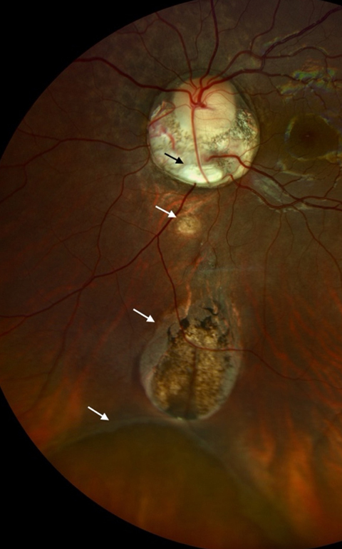 Fundus examination revealed a normal optic disc surrounded by peripapillary atrophy enclosing a chorioretinal coloboma (C, black arrow) at its inferior border and a combination of Ida Mann type (5, 6, 7) chorioretinal colobomas (C, white arrows) connected by bridging retinal tissue.