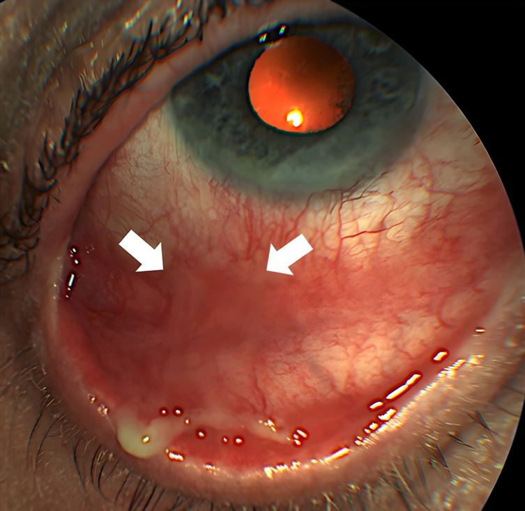 Slit lamp examination revealed formation of an inferior corneal pannus, inferior symblepharon, and conjunctival subepithelial fibrosis alongside conjunctival inflammation.