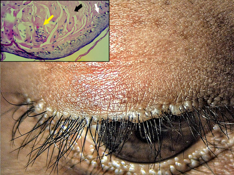 Incisional biopsy revealed irregular acanthosis (white arrow), deposition of eosinophilic material in the dermis (black arrow) and pinkish material around blood vessels and adnexa (yellow arrow), confirming the diagnosis of lipoid proteinosis.