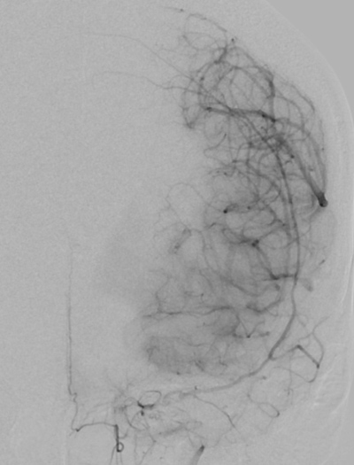 Appearance of “puff of smoke” concerning for moyamoya disease.