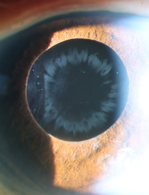 Slit lamp examination revealed pseudoexfoliation material on the anterior surface of the IOL in multiple linear patterns in the right eye on oblique illumination.