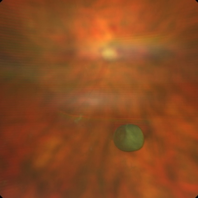 The image shows a solitary translucent, brown-pigmented vitreous cyst observed in the anterior vitreous cavity in a 73-year-old man who was asymptomatic on presentation for routine examination.