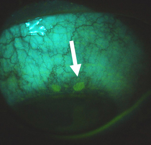 Conjunctival hyperemia and ulcers were observed in the perilimbal, bulbar, and tarsal conjunctiva, which stained positively with fluorescein under a cobalt-blue filter.