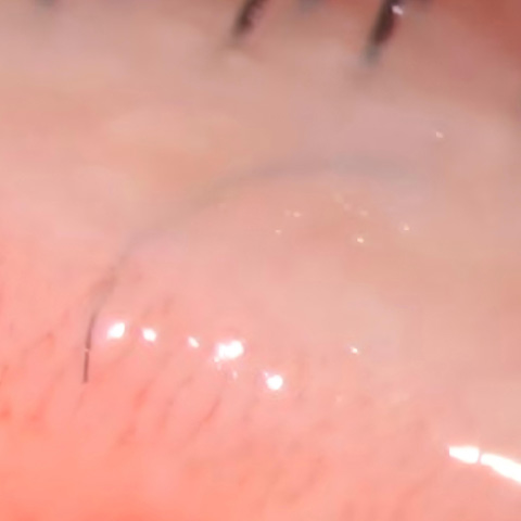 The hair follicle was located on the anterior lip of the eyelid margin, but the eyelash was limited by the epidermis and grew beneath it, leading to an inward growth.