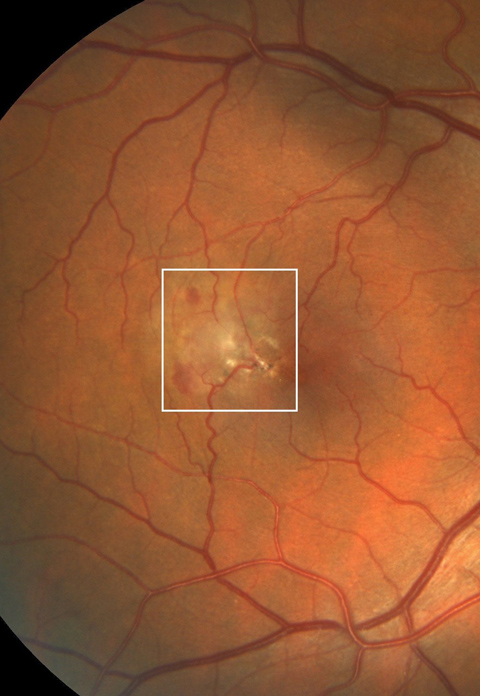 Fundus examination revealed parafoveal loss of transparency, right angle venules, and telangiectatic vessels, more prominent temporally in the macula of each eye.