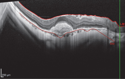 OCT of the right eye showing no intraretinal fluid but persistence of hyperreflective material after a single dose of intravitreal faricimab.