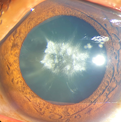 Electric shock–induced cataract.