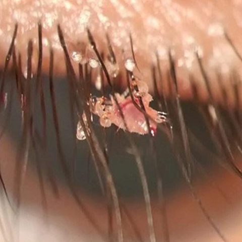 Slit lamp examination revealed red, crusty eyelid margins and mild conjunctival hyperemia, with lice moving over the eyelashes, along with nits at the base.