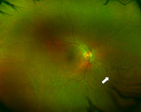 Case 1, pretreatment multimodal Imaging. Ultrawide-field color fundus photographs showing scant inferonasal bone spicules (white arrows).