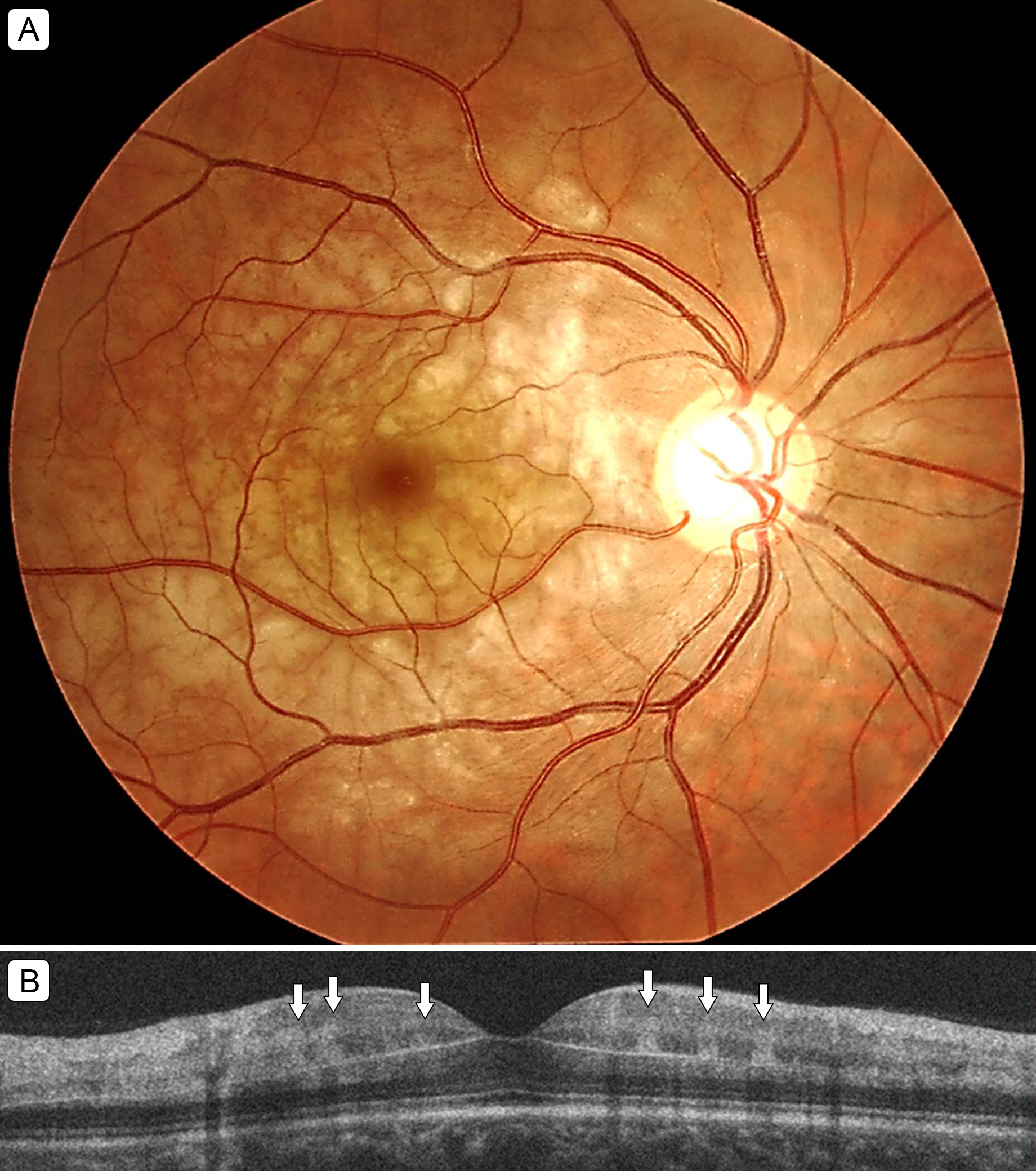 Ophthalmoscopic examination revealed fernlike retinal edema in the right eye (A); however, no cherry-red spot was detected. Optical coherence tomography showed hyperreflective bandlike lesions involving the middle layers of the retina at the level of the inner nuclear layer (B, arrows).