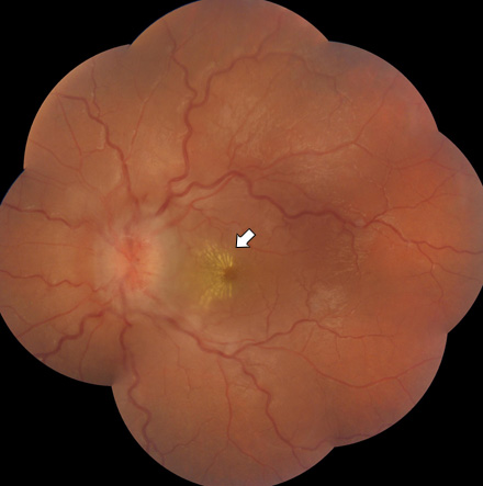 Fundus examination demonstrated optic disc hyperemia and swelling bilaterally, accompanied by macular star formation, more pronounced in the right eye (arrow), consistent with bilateral neuroretinitis.