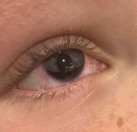 External photograph showing a 3 mm layered hyphema in the right eye on initial presentation.