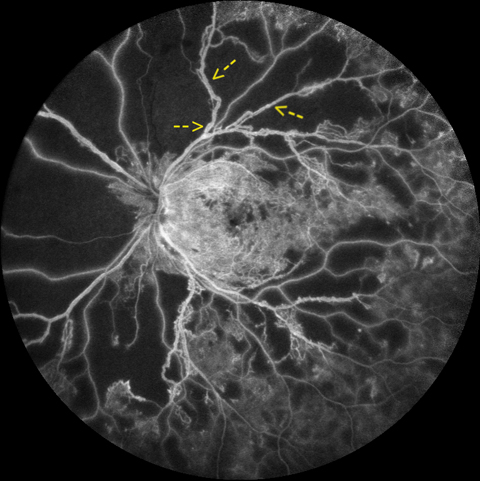 Proliferative diabetic retinopathy