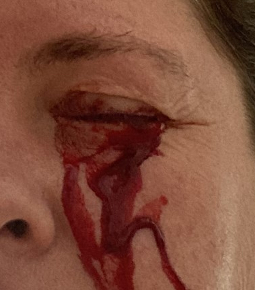 Profuse bleeding from the left eye on presentation.
