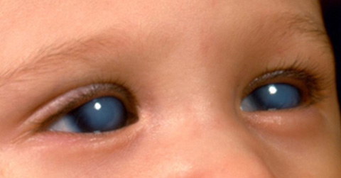 One of the sample images used to evaluate the image search recognition capabilities of chatbots for congenital glaucoma.