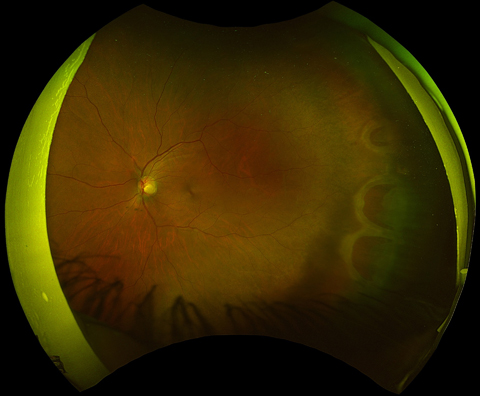Horseshoe tears in the retina