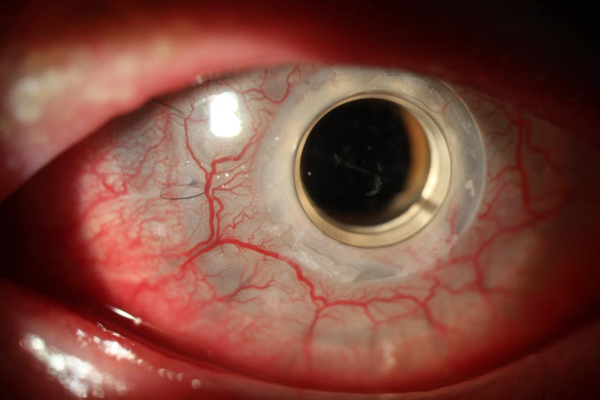 Left eye KPro at 4-month follow-up.
