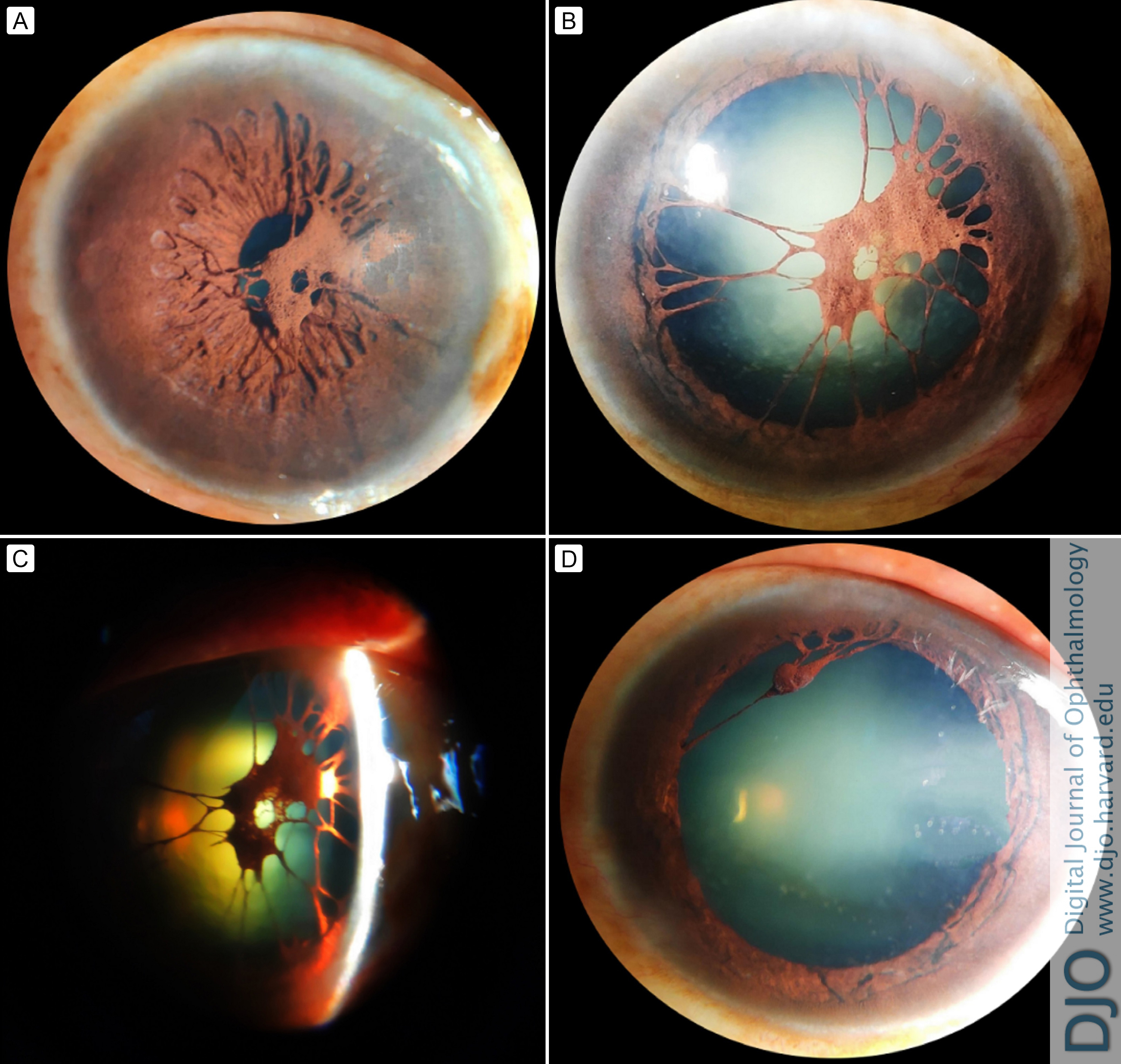 Bilateral persistent pupillary membrane in a 58-year-old woman