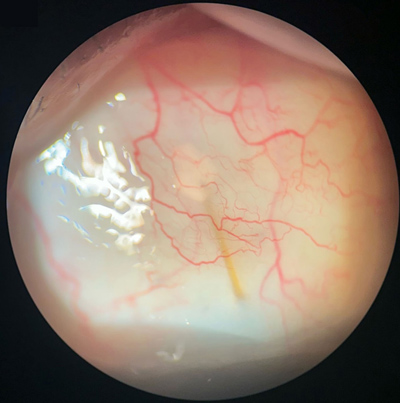 Subconjunctival injection of triamcinolone acetonide (40 mg/mL) around the XEN stent resolved the choroidal detachment in 1 week.