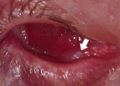 Squamous cell carcinoma in the inferolateral aspect of conjunctiva of the lower lid in anophthalmic socket. Note subtle plaque of keratinazation. with no feeding vessels (white arrow).