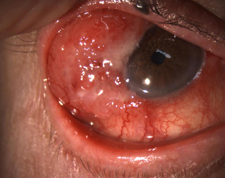 Clinical images of recurrent right superotemporal conjunctival mass