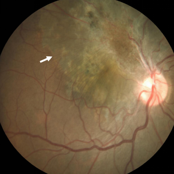 Retinal detachment in combined hamartoma of the retina and retinal pigment epithelium