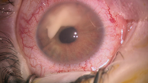 Hypopyon-like mass in the left eye, with increased vascularization of the iris.