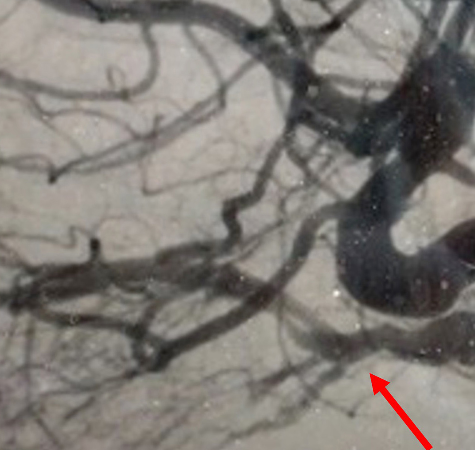 Cerebral angiogram showing indirect right carotid-cavernous fistula with supply from right internal carotid artery and right external carotid artery (internal maxillary artery) branches (red arrow)