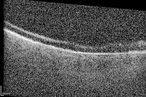 OCT macula on day 56 postinjection had poor image quality due to obstructed view to the posterior segment. Macular thinning and hyperreflectivity are indicative of ischemia.