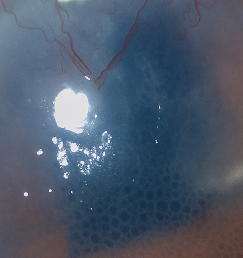 Within days of starting netarsudil, the patient developed a distinctive honeycomb-like pattern of corneal edema, most prominent in the central and inferior paracentral cornea.