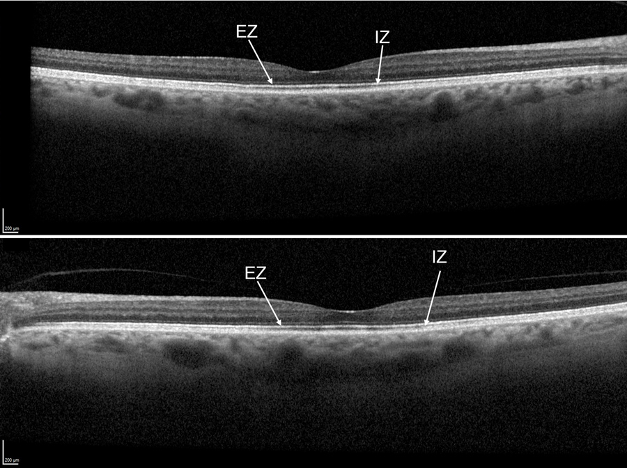 Macular OCT scans showed subtle thinning and reduced reflectivity of the interdigitation and ellipsoid zones subfoveally in both eyes.