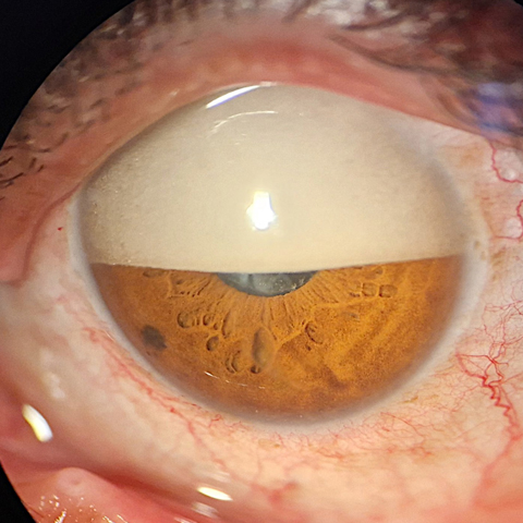 The image shows a classic reverse hypopyon, where emulsified silicone oil droplets accumulated in the superior anterior chamber due to their buoyancy.