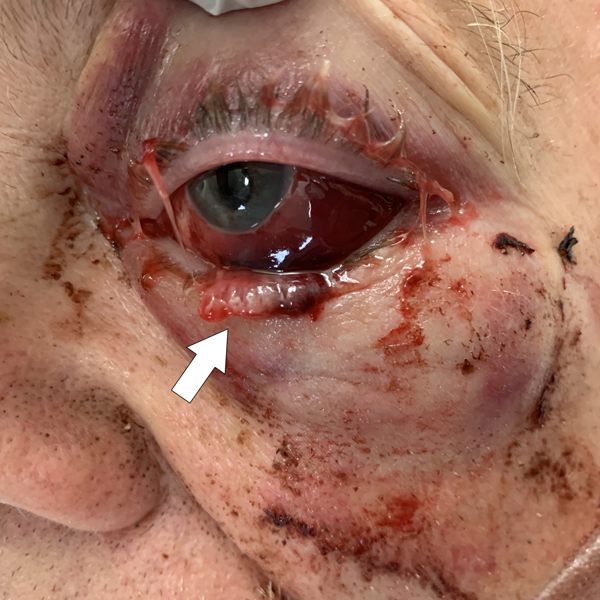 Inferior rectus muscle (arrow) protruding through the conjunctival laceration and sitting on the inferior eyelid.