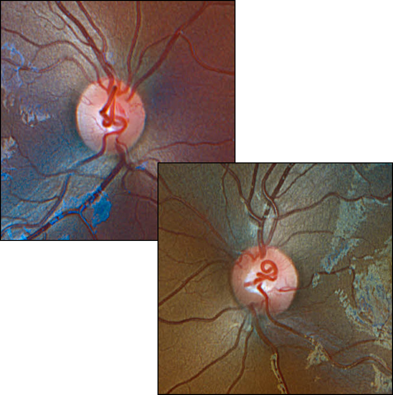 The figure shows color fundus photography of bilateral prepapillary vascular loops in a 12-year-old healthy boy who presented for a standard ophthalmologic evaluation.