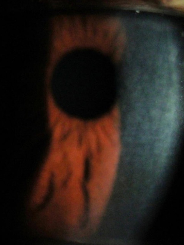 Slit-lamp examination revealed small, polygonal, deep stromal opacities in the central cornea, separated by clear areas of normal stroma in both eyes.