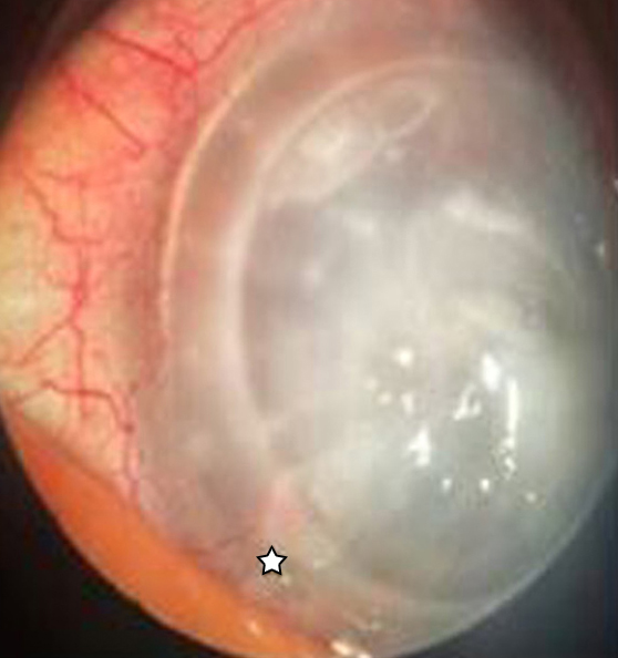 Newly formed vessels were observed between 4 and 5 o’clock at 12 weeks postoperatively. The eye became white with evident lipid keratopathy and neovascularization regression.