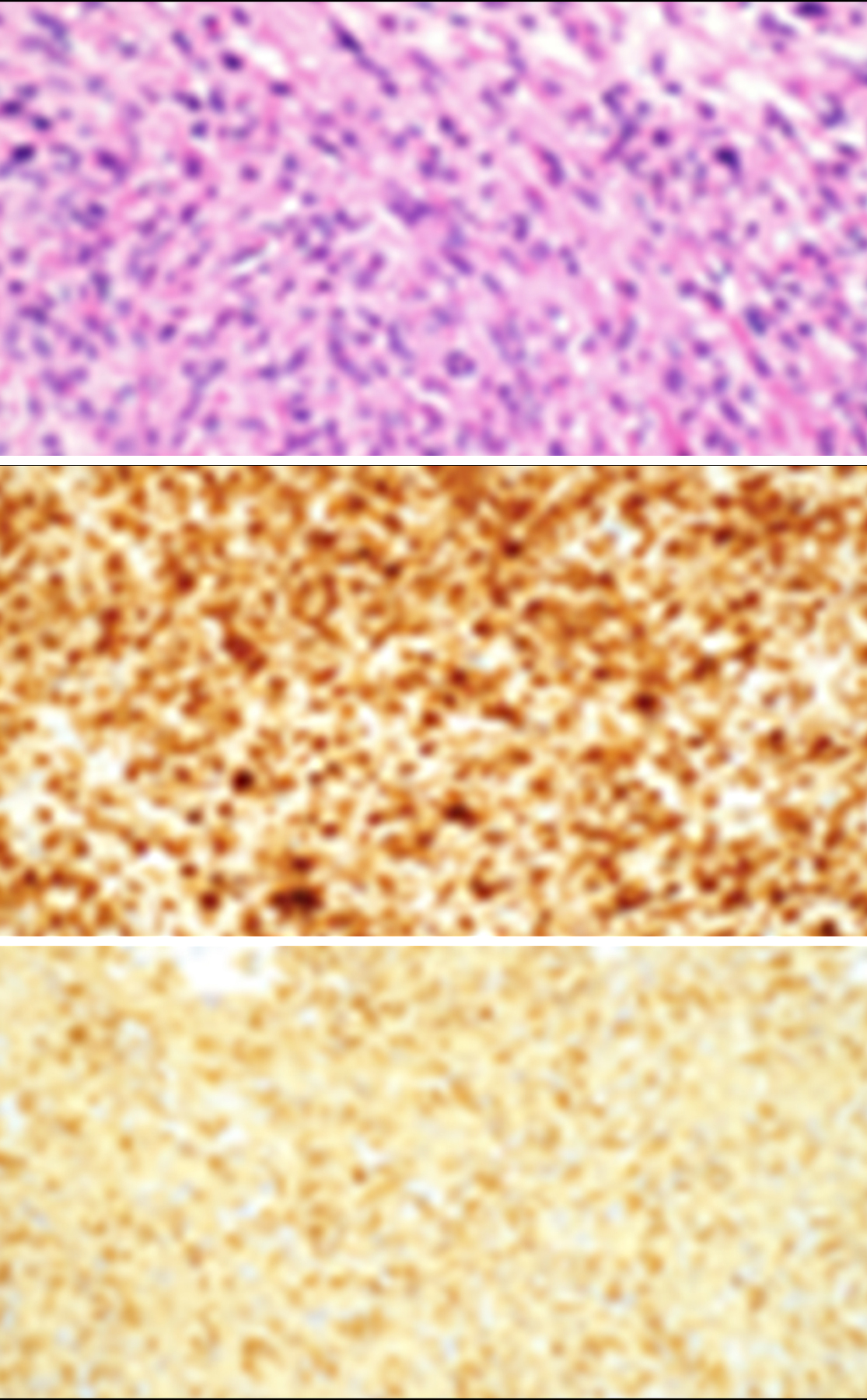 On hematoxylin and eosin stained sections, the pathology of the uterine tumor demonstrated spindle-shaped cells with eosinophilic cytoplasm and elongated, cigar-shaped nuclei with mitotic figures and areas of ischemic degeneration (A). The lesion was immunopositive for desmin (B) and smooth muscle actin (C), in keeping with a leiomyosarcoma