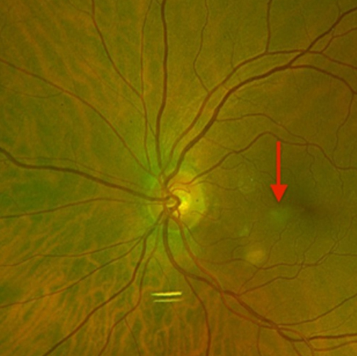 Fundus photograph showing faint area of retinal whitening indicating ischemia that is nasal to the fovea (red arrow)