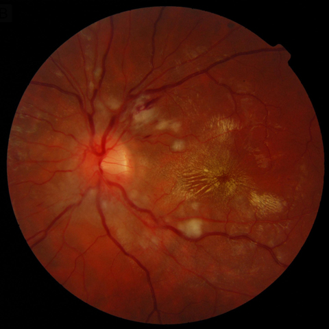 Left eye of a 14-year-old girl showing hard exudates in a macular star configuration (thin arrows) and cotton wool spots (thick arrows) with intraretinal hemorrhages and optic disc edema.