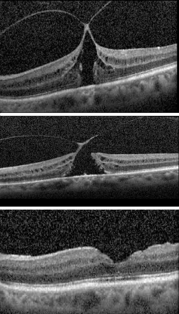 Case of vitreomacular traction with full-thickness macular holes that progressed in FTMH stage following phacoemulsification.