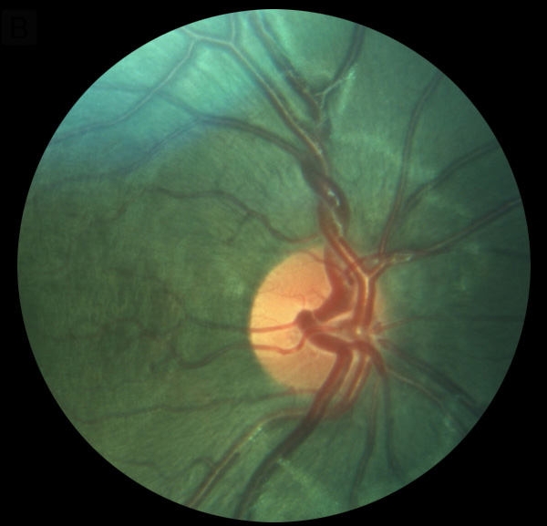 A 7-year-old boy with Coats disease  in his right eye, with ringlike exudation posteriorly and superotemporally