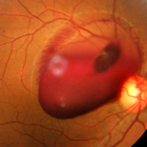 We present fundus illustrative images from 4 cases of acute premacular SHH. All 4 patients underwent immediate Nd:YAG laser–assisted hyaloidotomy.