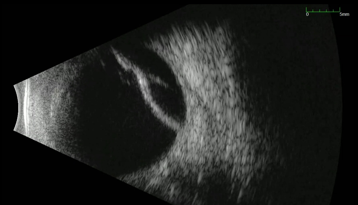 Dynamic B-scan ultrasonography revealed a mobile, irregular, hyperechoic membrane with an underlying bridging structure indicative of a serous choroidal effusion.