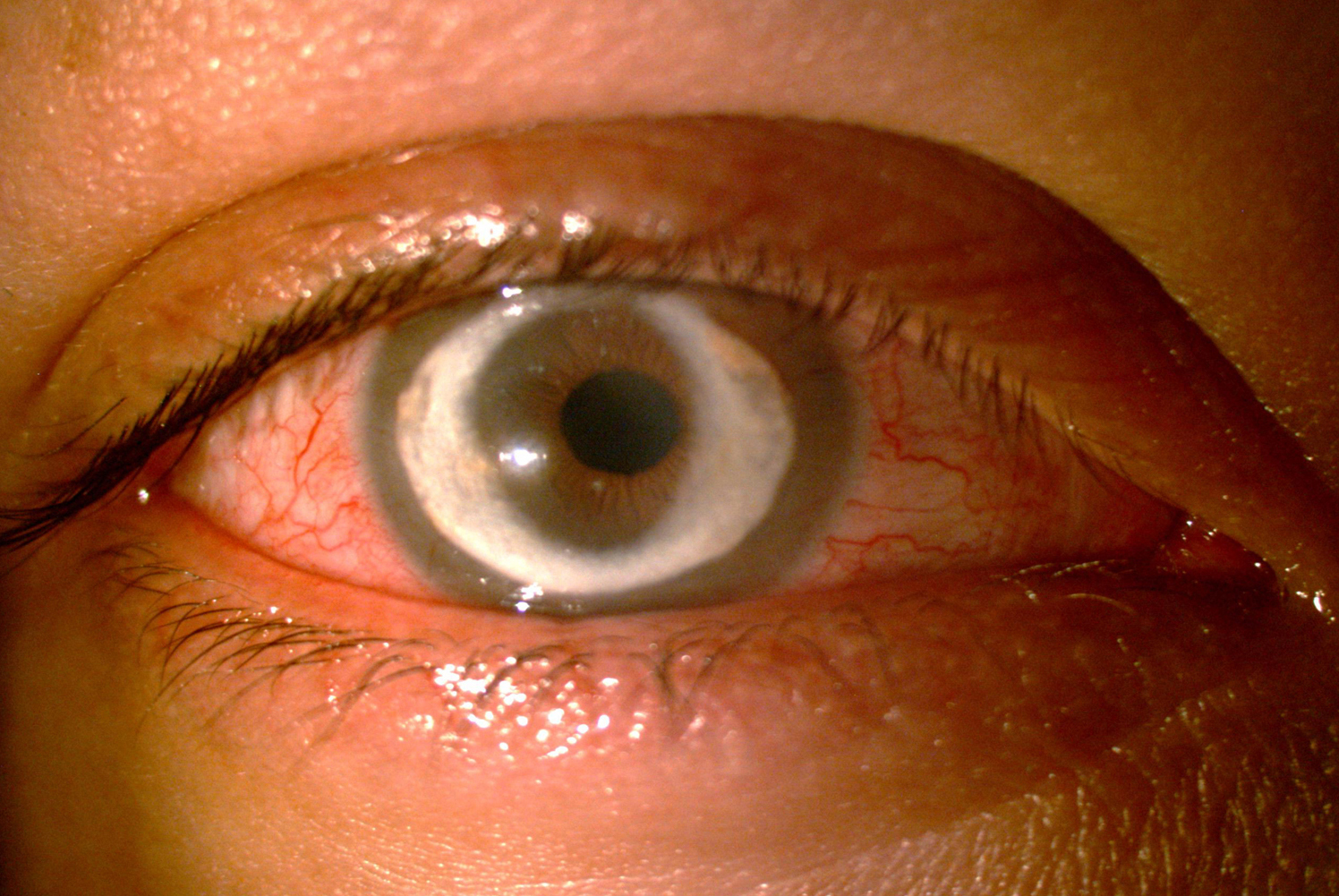 Slit lamp photograph showing inflammation and crystalline deposits on the corneal stroma.