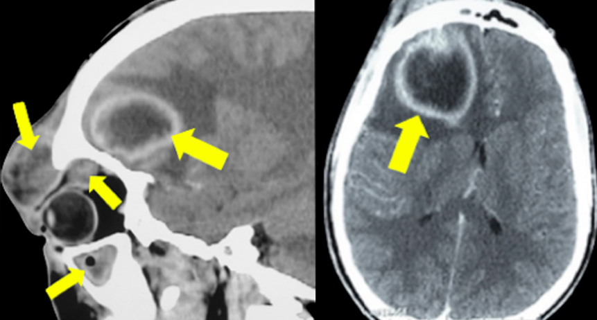 Orbital-cerebral computed tomography revealed an associated orbital abscess extending to the upper eyelid, pansinusitis, and a frontal cerebral abscess.
