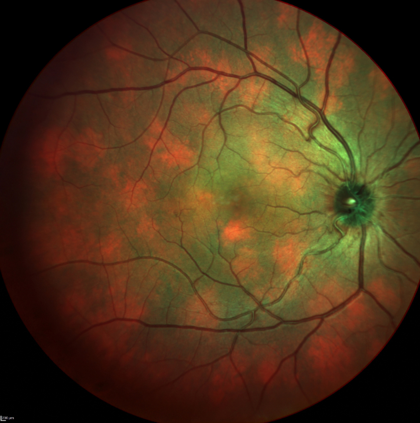 Choroidal nodules in a patient with neurofibromatosis type 1