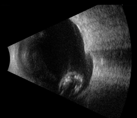 B-scan ultrasound of the right eye revealed a luxated lens lodged in a retinochoroidal coloboma.